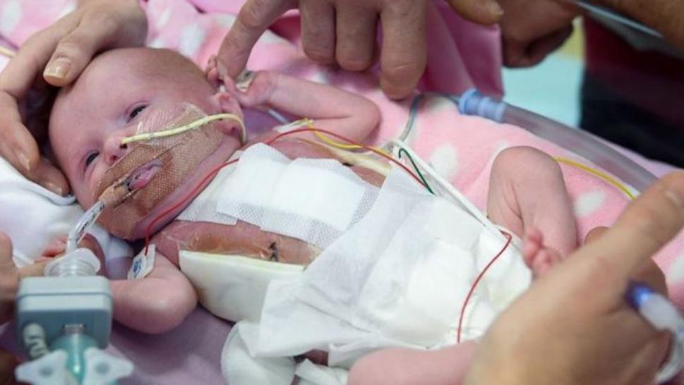 Baby Girl born with heart outside her body survives surgery