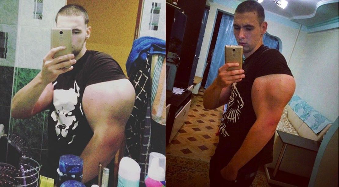 Kirill Tereshin: Russian body-builder faces having limbs amputated