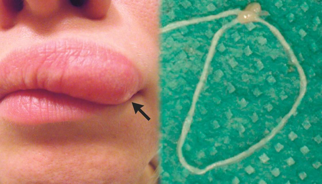 Lump was a worm? Lump on Woman's Face Turns Out to Have Living Thing Inside