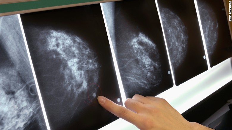 New breast cancer guidelines screenings, 4,000 more women could die